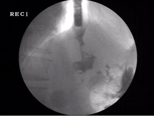 Dysphagia in a post operative case