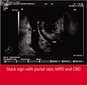 Recurrent Pancreatitis in a Young Male