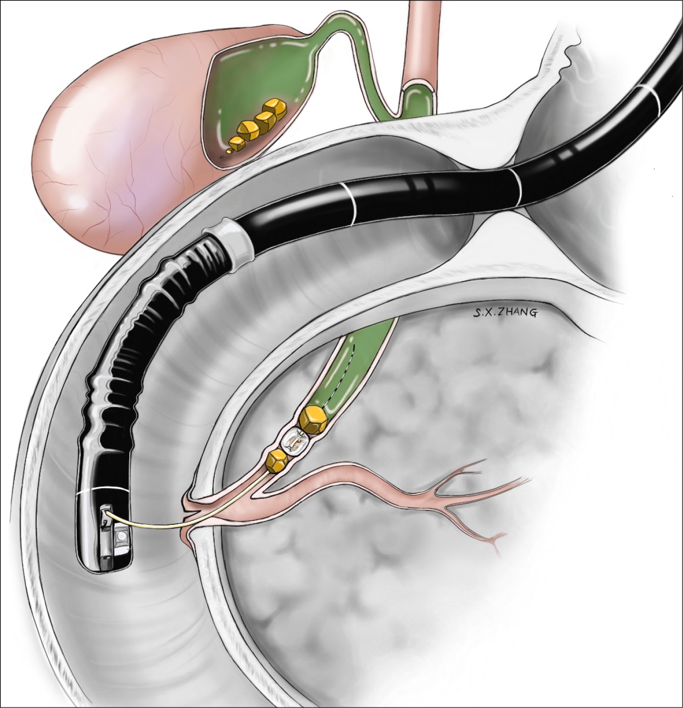 Know all about ERCP - Endoscopic Retrograde Cholangio-Pancreatography Procedure - Dr. Chirayu Chokshi